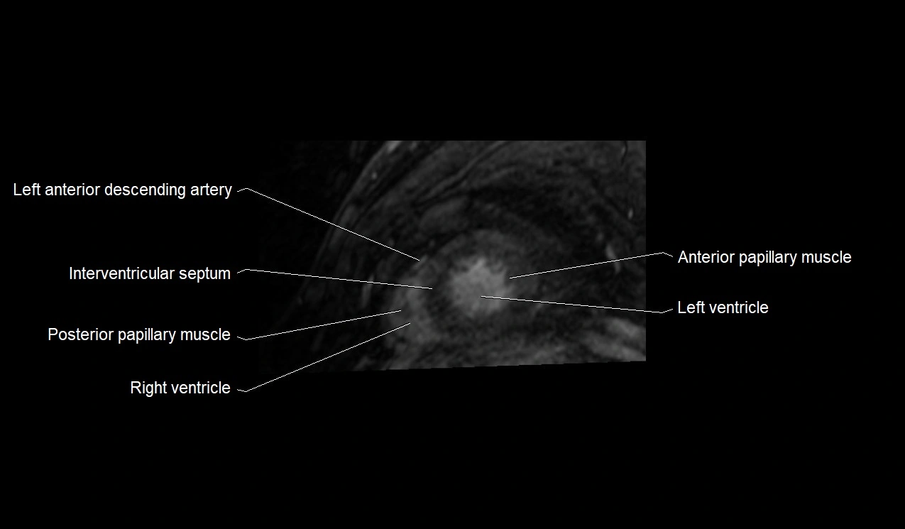 MRI heart and coronary arteries short axis anatomy image 34.webp